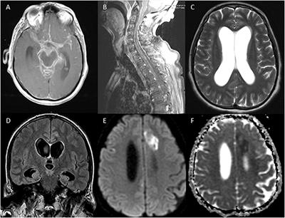 A Critically Ill Patient With Central Nervous System Tuberculosis and Negative Initial Workup